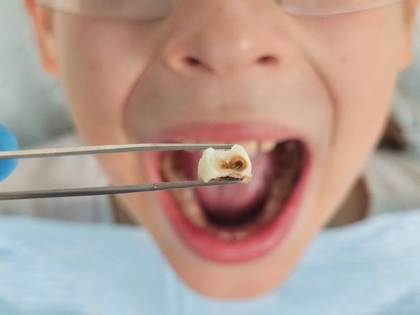 Best Emergency Wisdom Teeth Removal in Cricket, NC